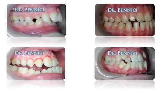 Laser dentale 2