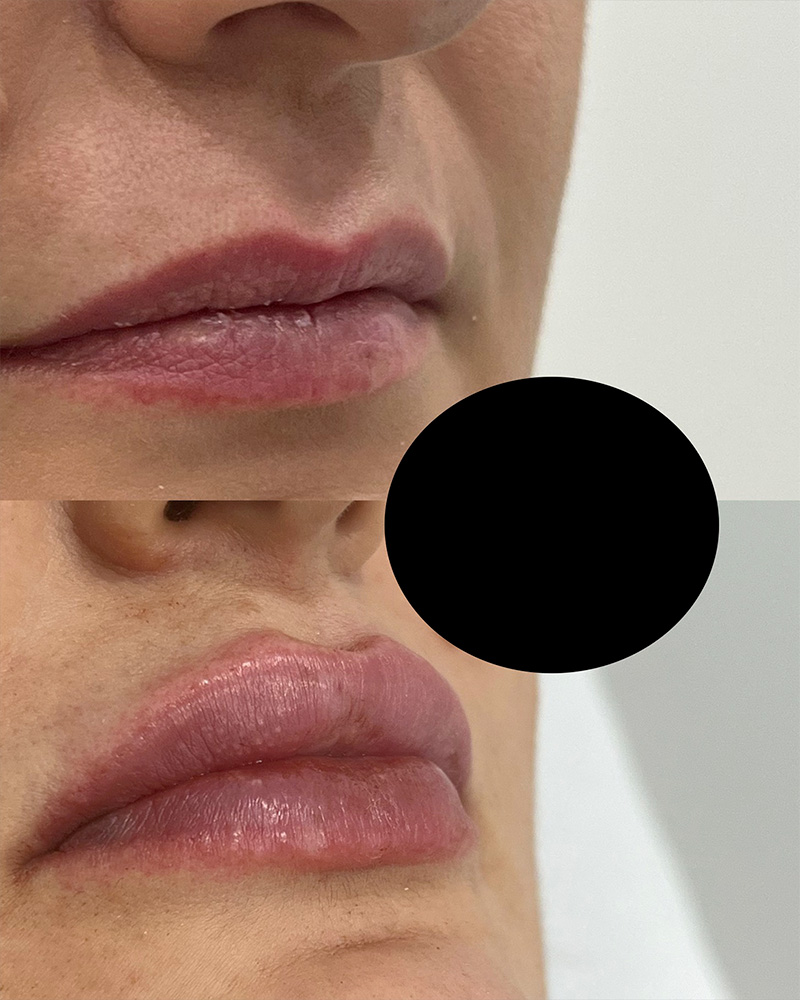 Filler labbra caso 1