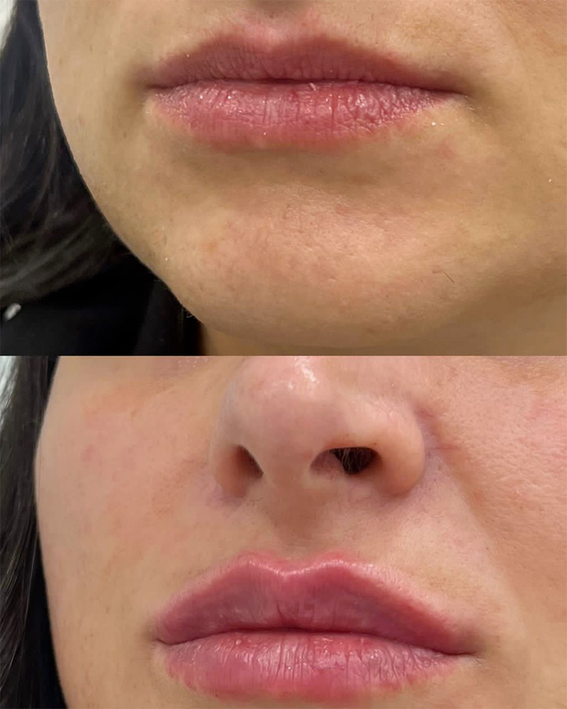 Filler labbra caso 2
