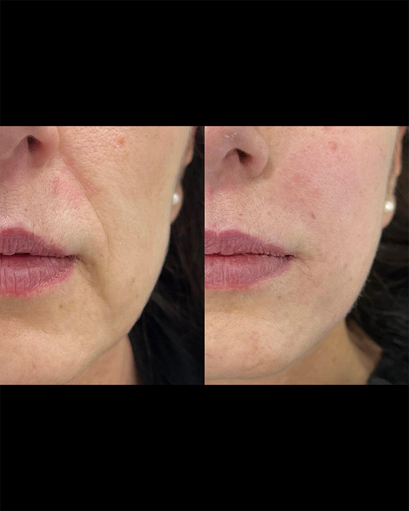 Filler labbra caso 3