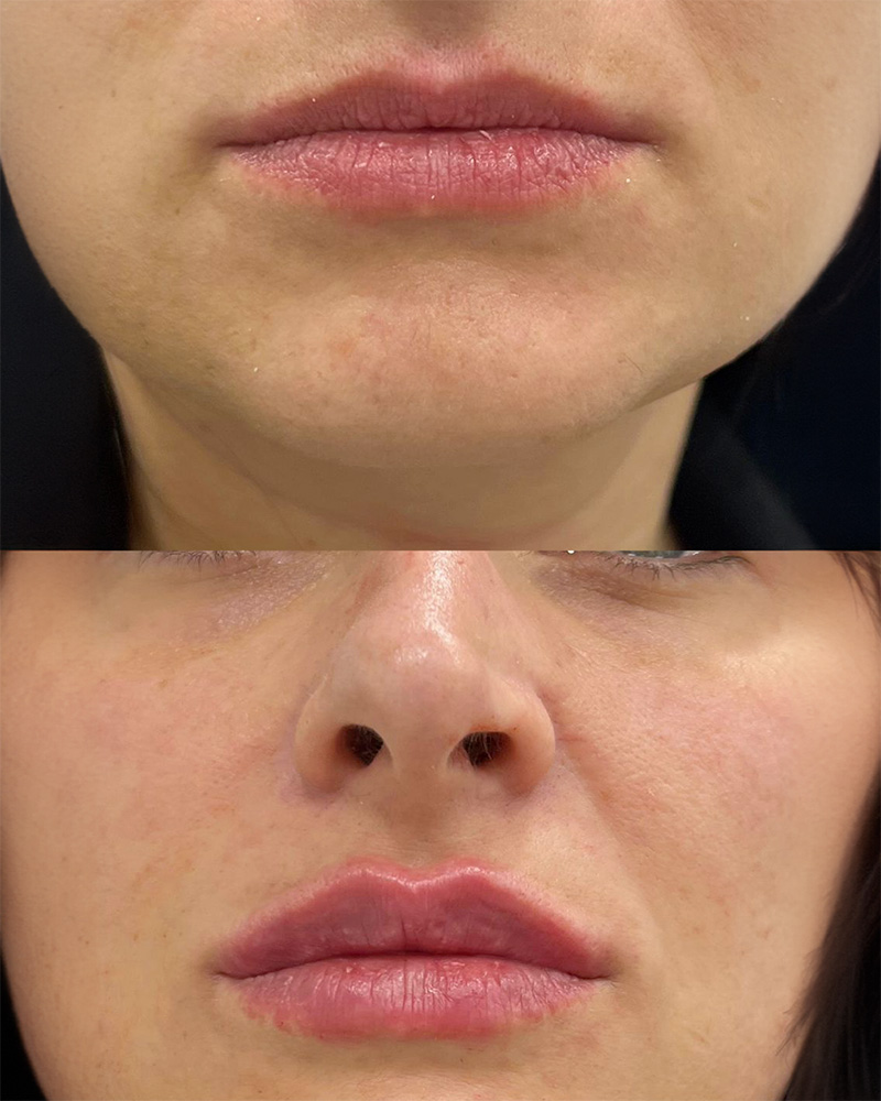 Filler labbra caso 6
