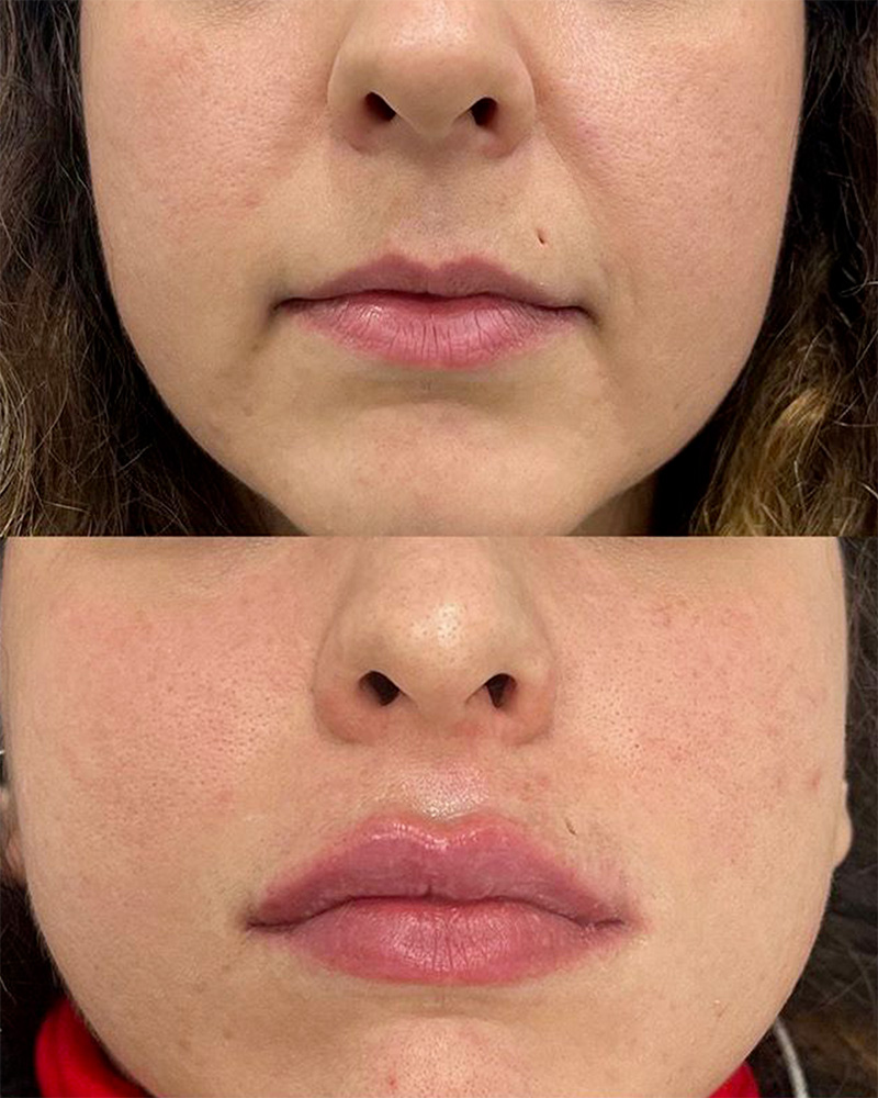 Filler labbra caso 7