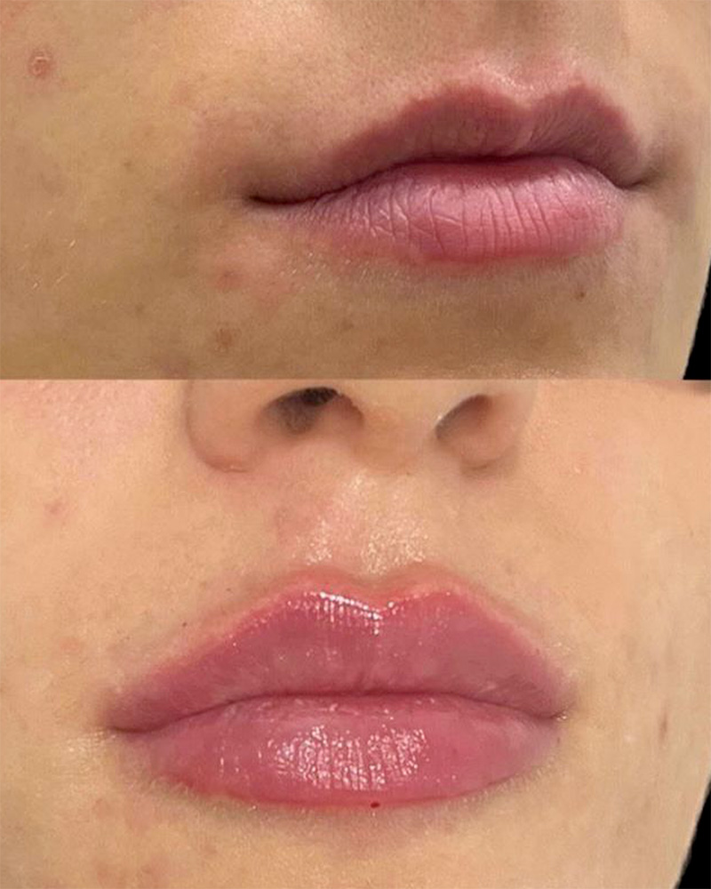 Filler labbra caso 8