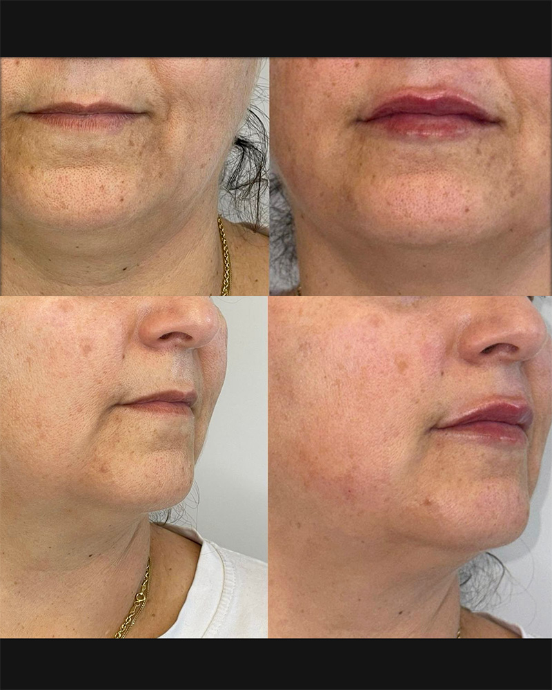 Filler labbra caso 9
